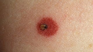 How to Spot Lyme Disease  WebMD [upl. by Kelli]