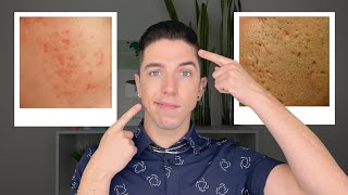 How to Get Rid of Acne Scars [upl. by Petersen875]