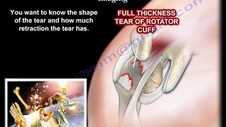 Lesions Of The Shoulder SLAP Tear  Everything You Need To Know  Dr Nabil Ebraheim [upl. by Raymonds]