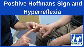 Positive Hoffmans Sign and Hyperreflexia [upl. by Paule242]