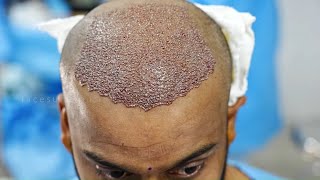 Hair Transplant Live Surgery  Hair Transplant FUE Technique Best Hair Transplant results [upl. by Anihpled]