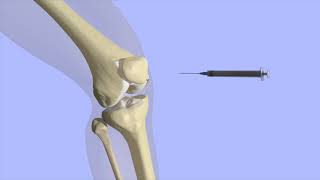 Knee Joint Injection [upl. by Orvie]