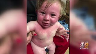 Child Has Anaphylactic Reaction To Paint With DairyBased Ingredients [upl. by Esyned]