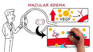 Retinal Vein Occlusion [upl. by Flavius]