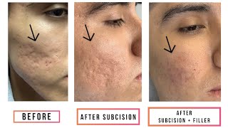 Subcision  Filler for Acne Scars [upl. by Tiga]