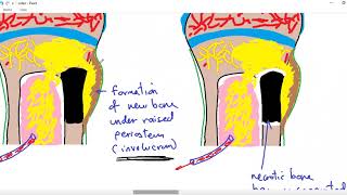 Systemic pathology 34  bone 4  osteomyelitis  DRSAMEH GHAZY [upl. by Giffer]