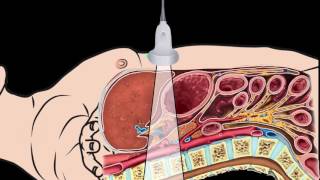 Introduction Abdominal Aorta Focused Ultrasound Examination [upl. by Kiefer362]