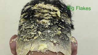 DRY SCALP  Big Flakes Dandruff Scratching Satisfying Video 768 [upl. by Einnol888]