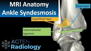 MRI Anatomy of Ankle Ligaments Syndesmosis [upl. by Niwred]