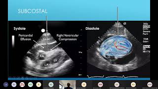 Pericardiocentesis in cardiac tamponade [upl. by Beffrey]