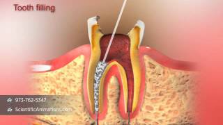 Root Canal Treatment [upl. by Pacifa48]