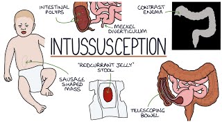 Understanding Intussusception [upl. by Aremaj]