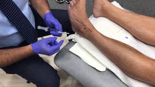 Ankle Steroid injection [upl. by Snave]