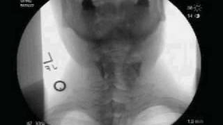 Videofluoroscopic Swallow Study [upl. by Custer]