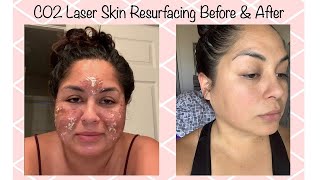 C02 Laser Resurfacing For Acne Scar Removal  My 7 Day Review [upl. by Berners]